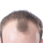 Truth About Hair Transplants