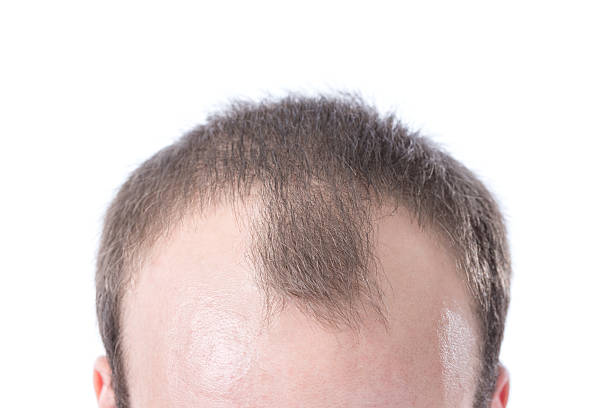 Truth About Hair Transplants